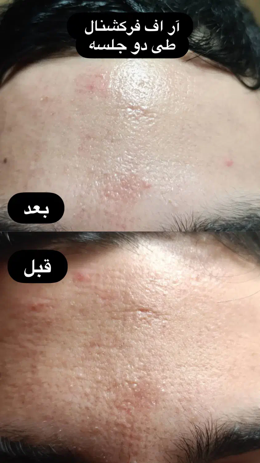 جشنواره زیبایی پوست با هایفوتراپی و آر اف فرکشنال|خدمات آرایشگری و زیبایی|قم, دورشهر|دیوار