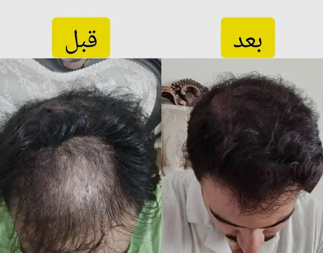 معجزه قرن/رشد ۳ برابری مو|آرایشی، بهداشتی، درمانی|خوشاب, |دیوار