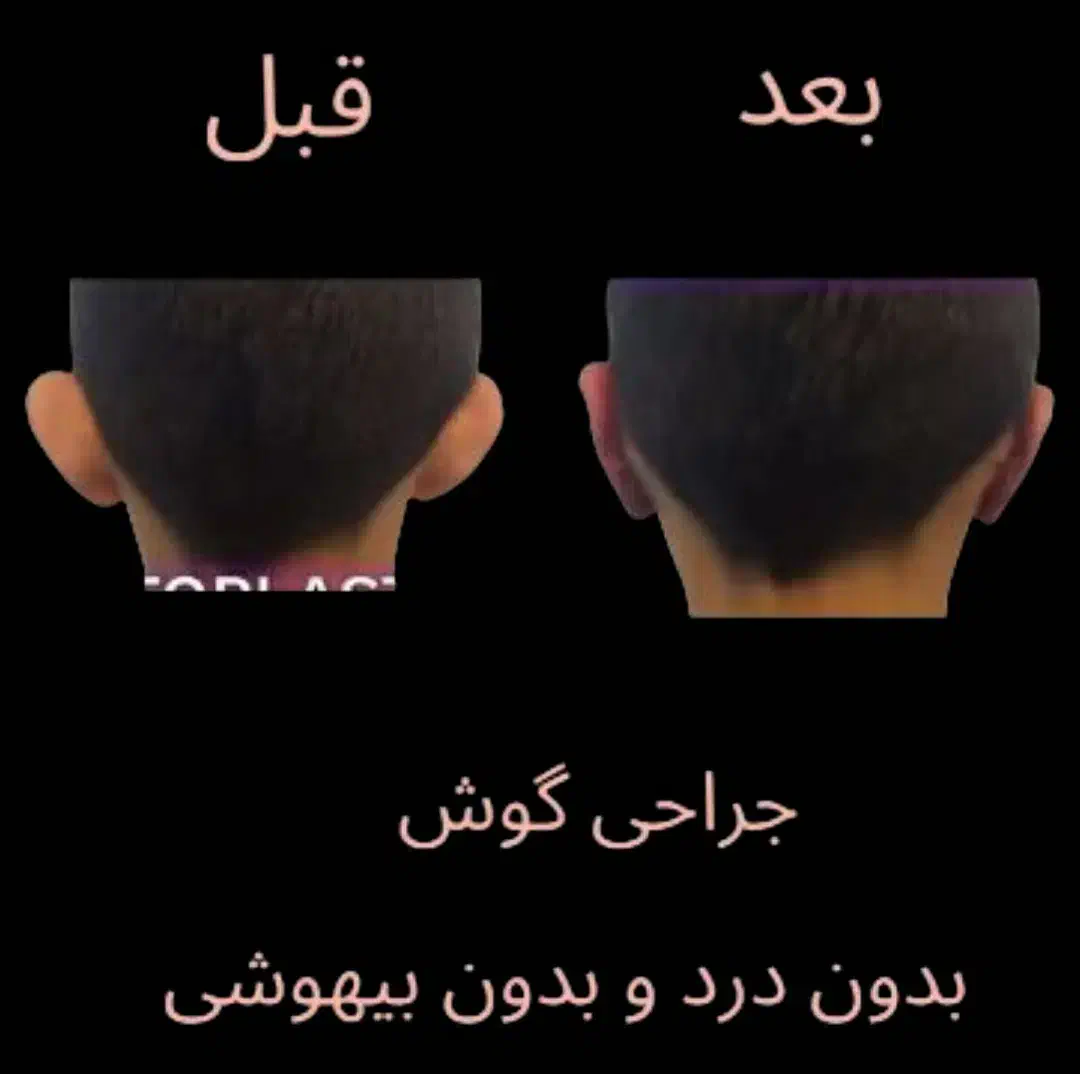 جراحی گوش با تخفیف ویژه|خدمات آرایشگری و زیبایی|تهران, باغ فیض|دیوار