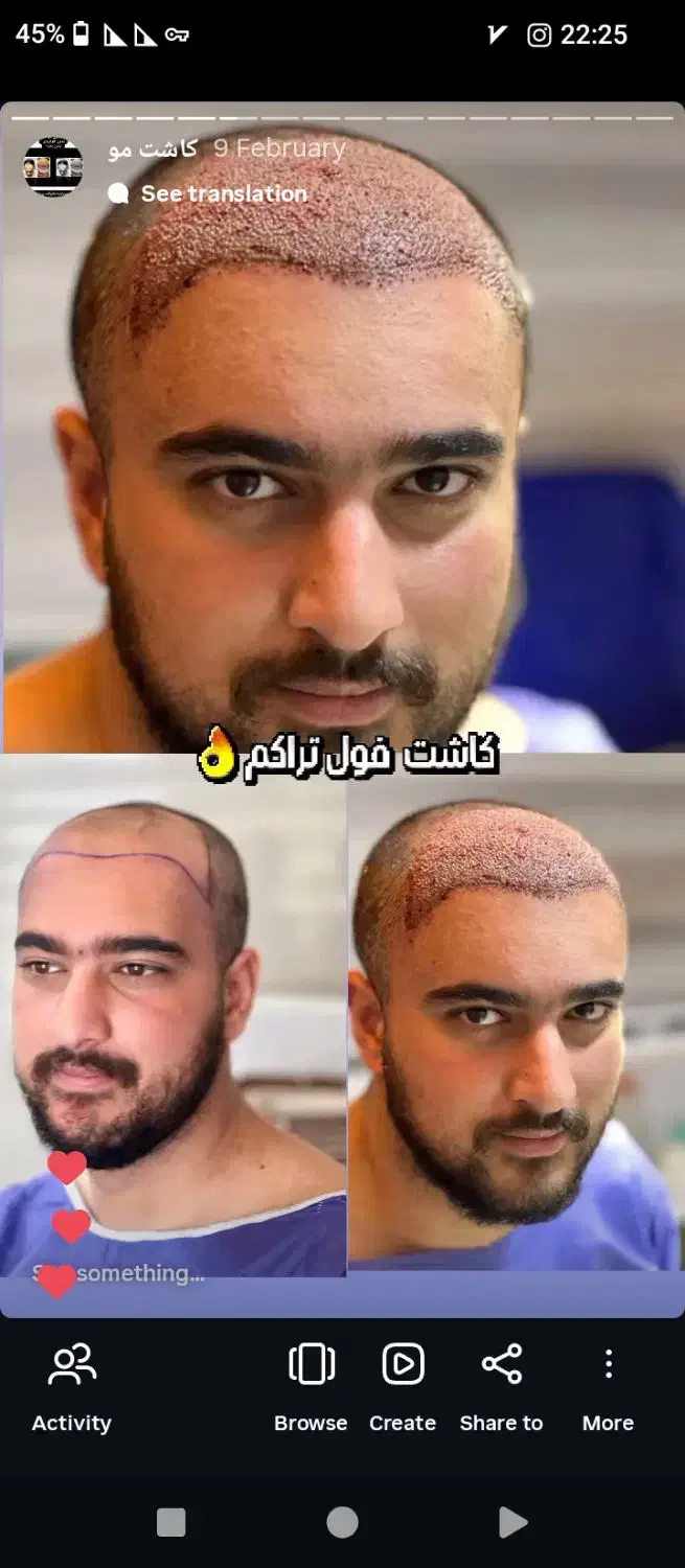 کاشت مو|خدمات آرایشگری و زیبایی|خوی, |دیوار