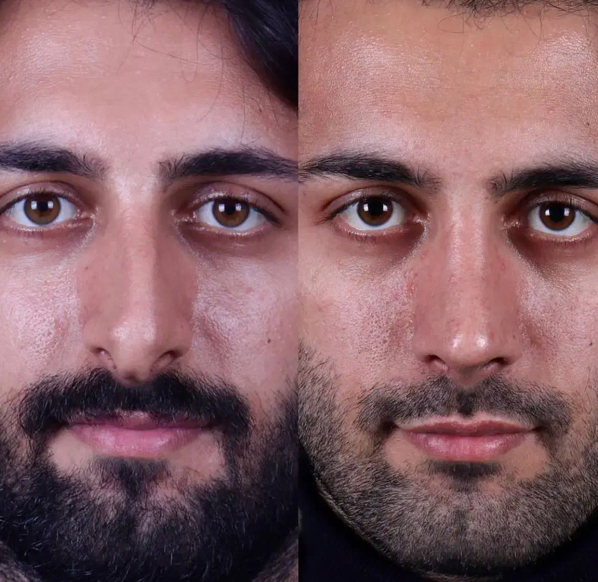 جراحی بینی در مجهز ترین کلینیک بدون تامپون|خدمات آرایشگری و زیبایی|تهران, شهر زیبا|دیوار