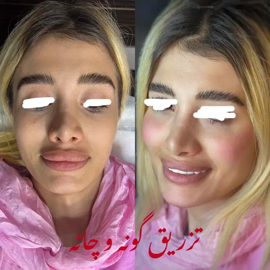 تزریق ژل فیلر بوتاکس و نخ لیفت با قیمت باورنکردنی|خدمات آرایشگری و زیبایی|رشت, گلسار|دیوار