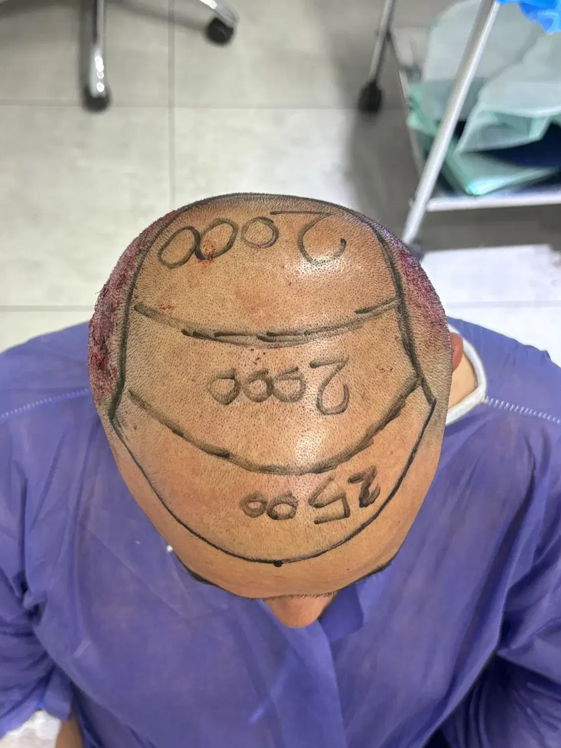 کاشت مو، ریش، ابرو|خدمات آرایشگری و زیبایی|تهران, الهیه|دیوار