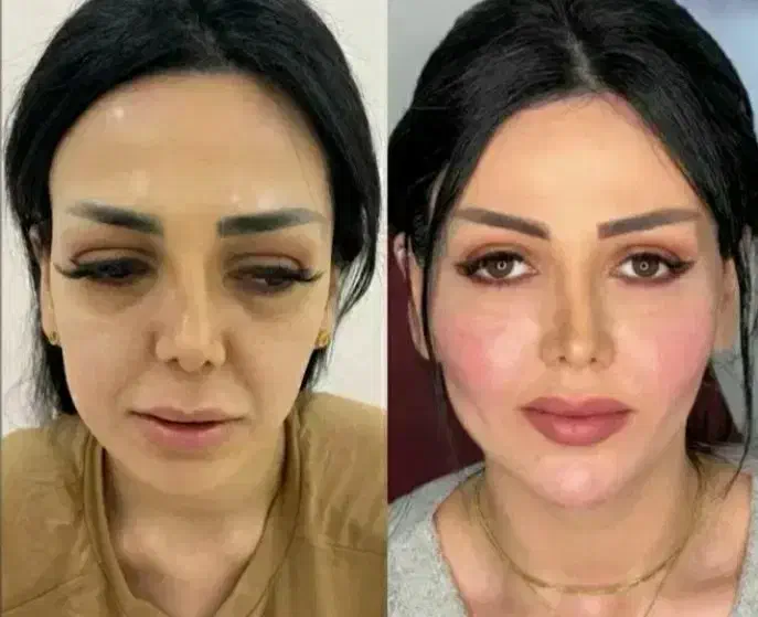 آف بلک فرایدی تزریق ژل بوتاکس فیلر ریمو تتو...|خدمات آرایشگری و زیبایی|علیآباد کتول, |دیوار