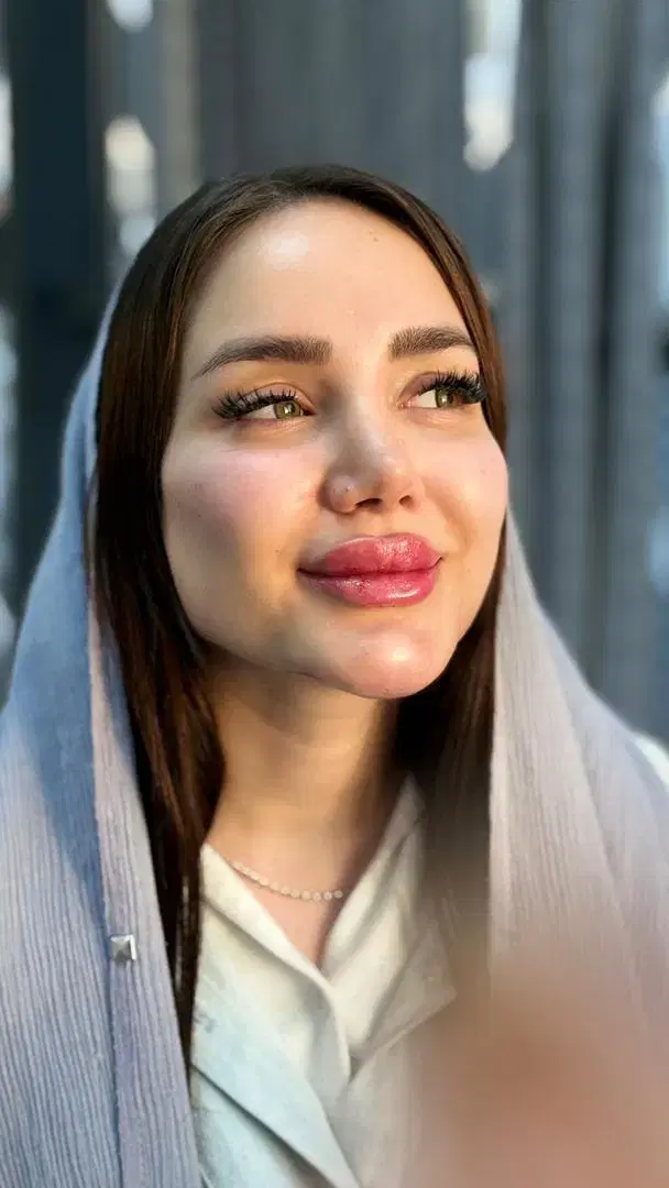 تزریقات ژل ،بوتاکس ،نخ با بهترین قیمت و متریال|خدمات زیبایی و سلامت|کرج, جهانشهر|دیوار