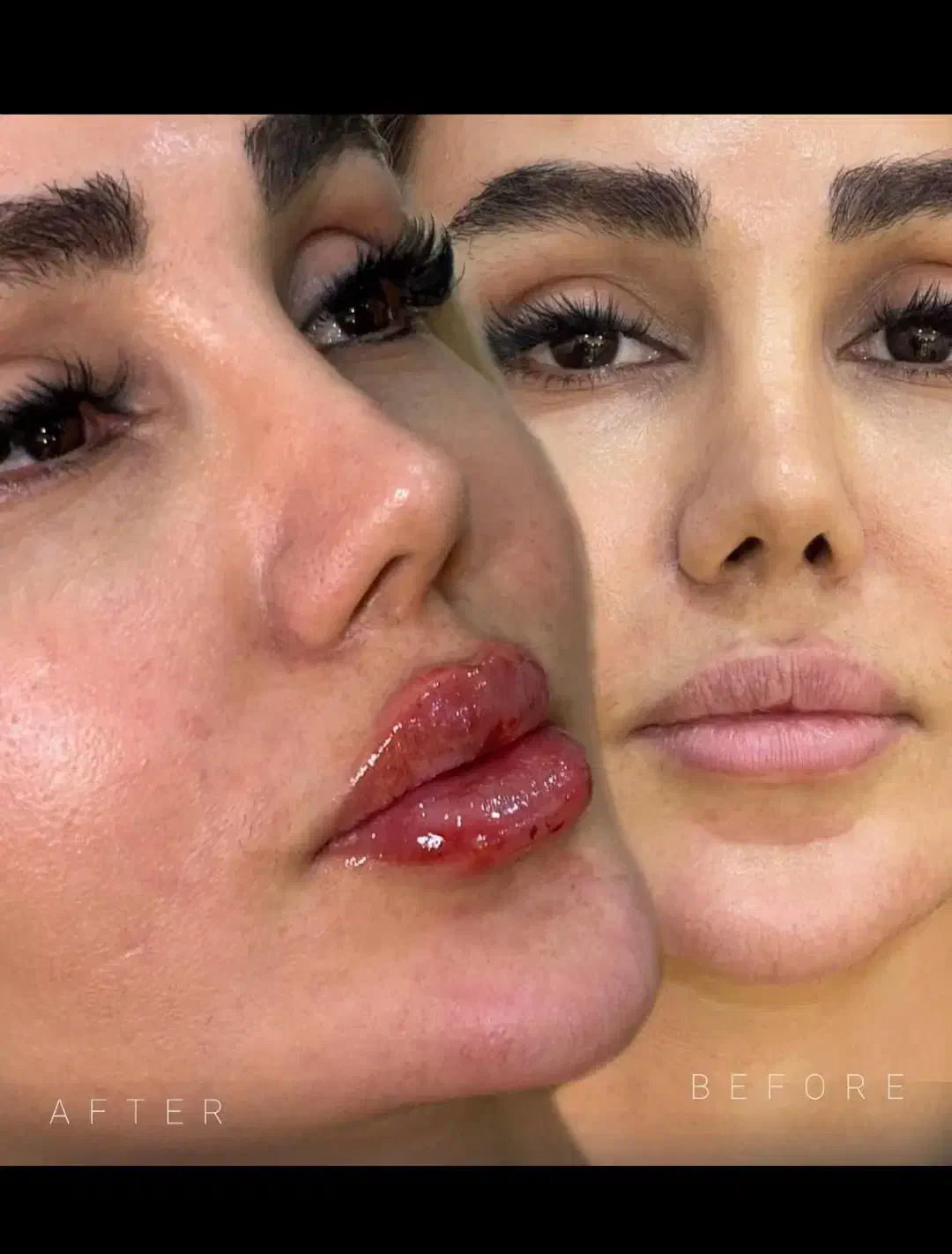 بوتاکس وفیلر صورت و بدن|خدمات آرایشگری و زیبایی|بیرجند, |دیوار