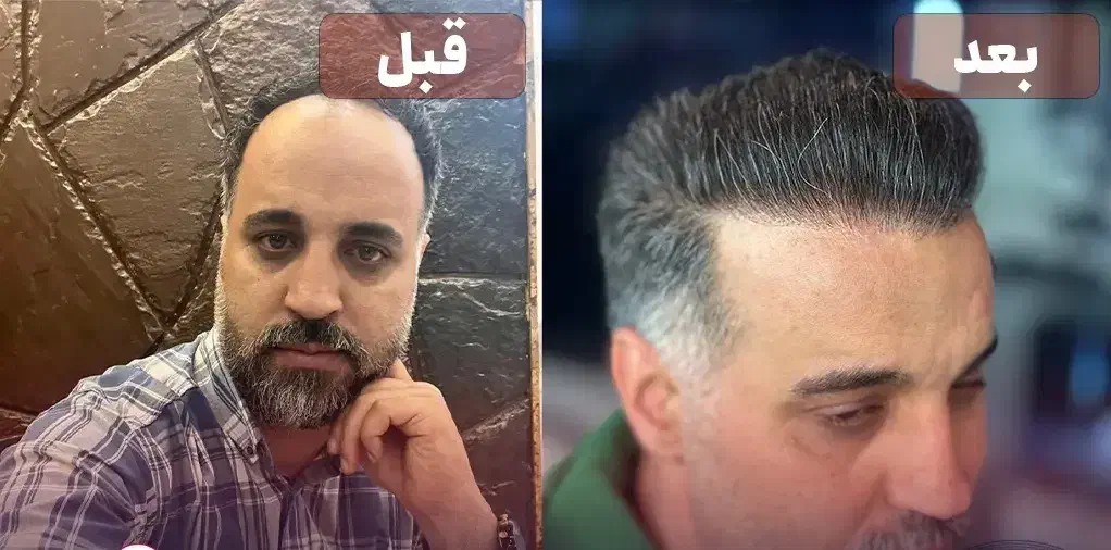 کاشت مو قیمت ۱۸میلیون با شرایط اقساطی|خدمات آرایشگری و زیبایی|اردبیل, |دیوار