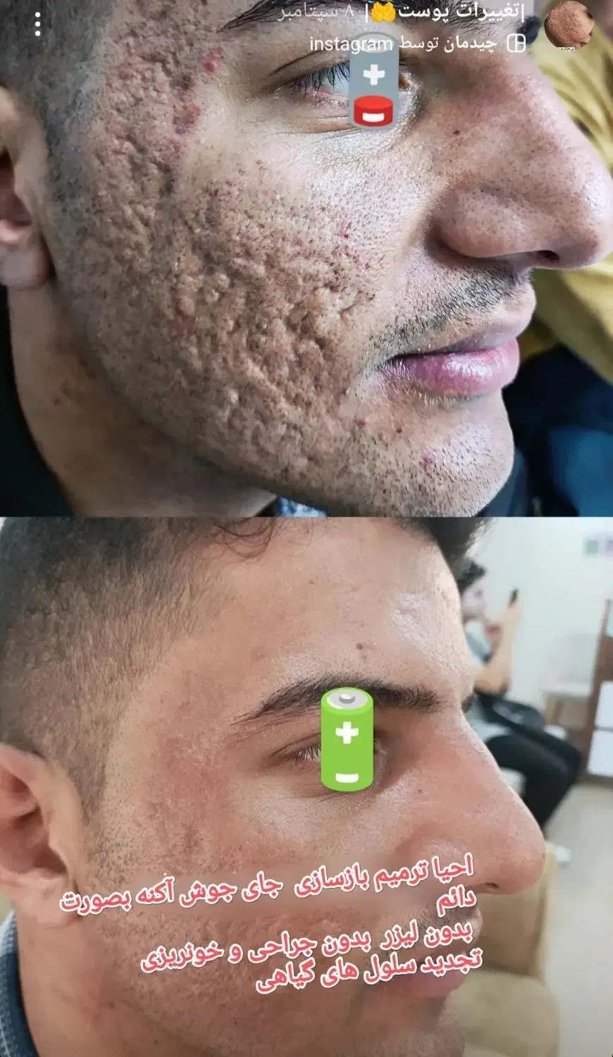 بازسازی درمان جای جوش آکنه باروش تخصصی NBR در کشور|خدمات آرایشگری و زیبایی|رشت, فلسطین|دیوار