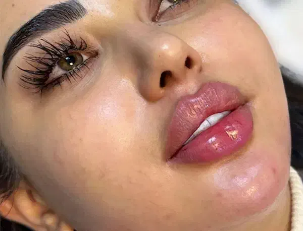 بوتاکس ژل لب گونه چانه فک پر کردن صورت لاغر نخ مزو|خدمات آرایشگری و زیبایی|قم, زنبیل آباد|دیوار