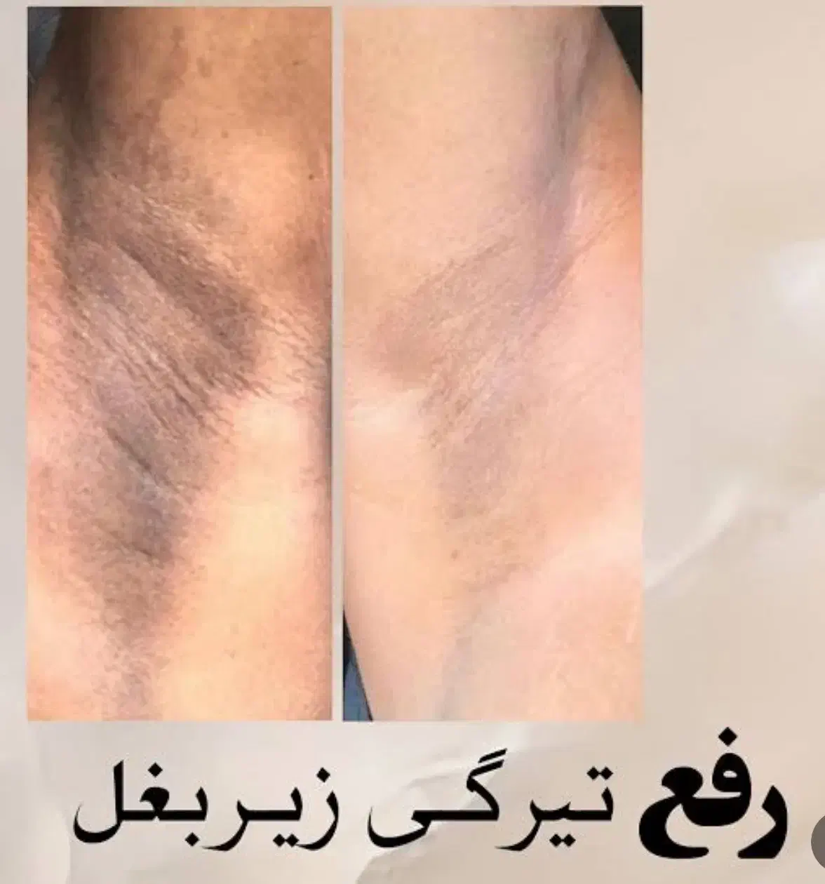 سفیدکردن‌نواحی تیره بدن|خدمات آرایشگری و زیبایی|ارومیه, |دیوار