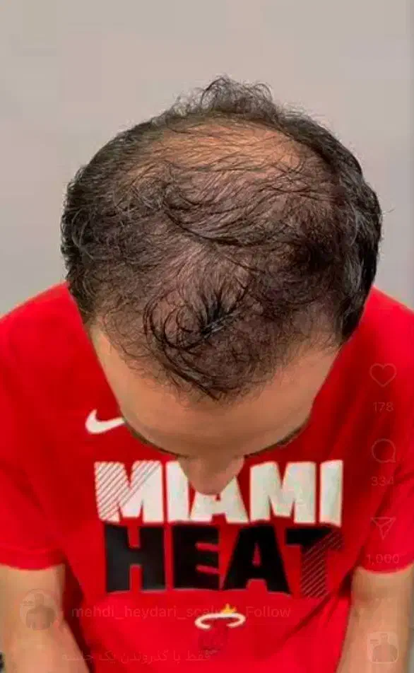 درمان قطعی ریزش مو و رد مجدد مو با پکیج درمانی H3|خدمات آرایشگری و زیبایی|شاهین‌شهر, خانه کارگر|دیوار