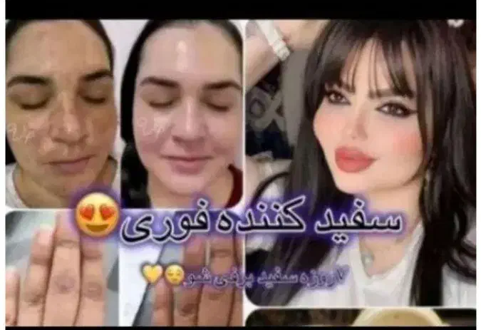 کرم معجزه روشن کننده قوی ضدلک جوش وتیرگی ضمانتی|آرایشی، بهداشتی، درمانی|سرپل ذهاب, |دیوار