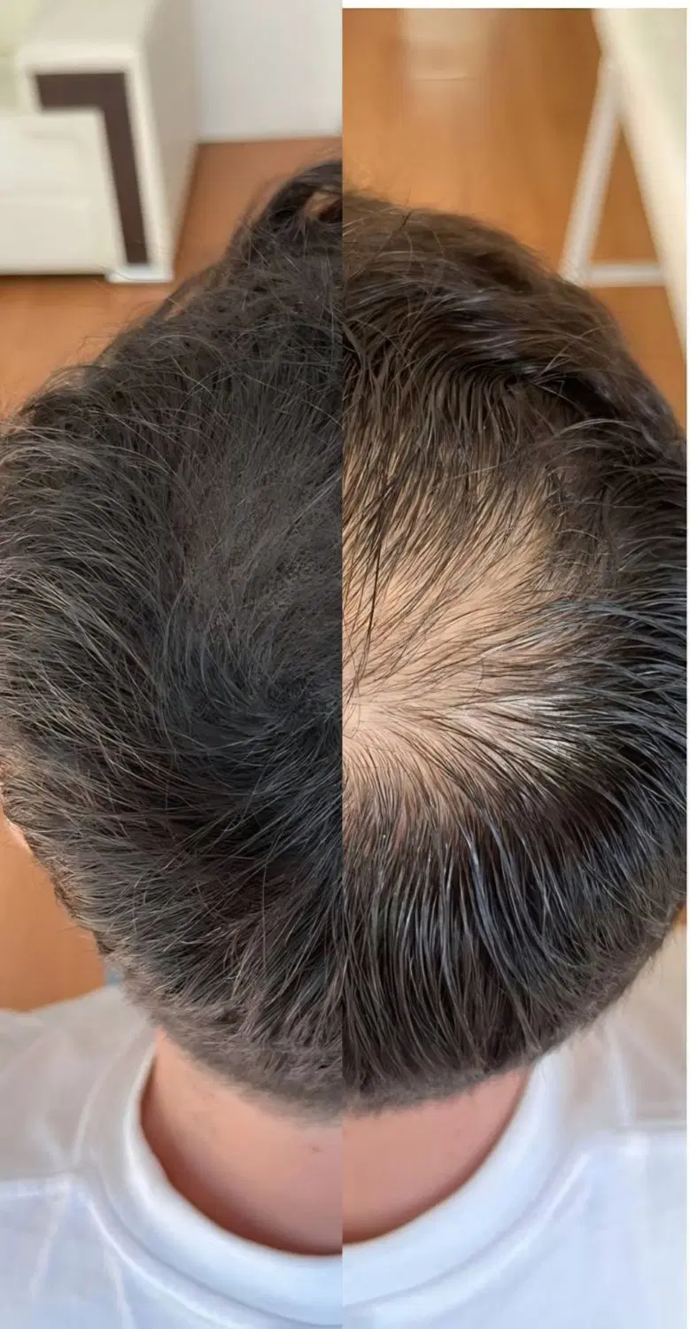 تکمیل کاشت مو با میکرو اسکالپ|خدمات زیبایی و سلامت|اصفهان, پوریای ولی|دیوار