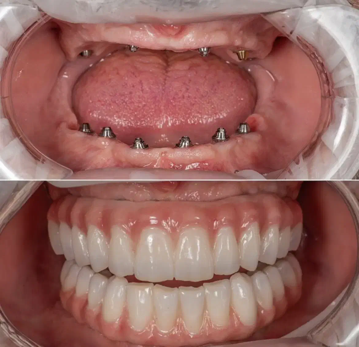 ایمپلنت،اوردنچر دو فک ۱۰۰ تومن در تبریز|خدمات آرایشگری و زیبایی|اهر, |دیوار