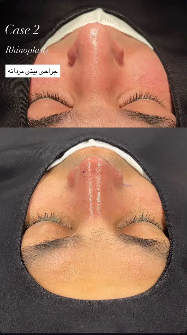 جشنواره عمل بینی به سبک جراحان ترکیه|خدمات آرایشگری و زیبایی|لامرد, |دیوار