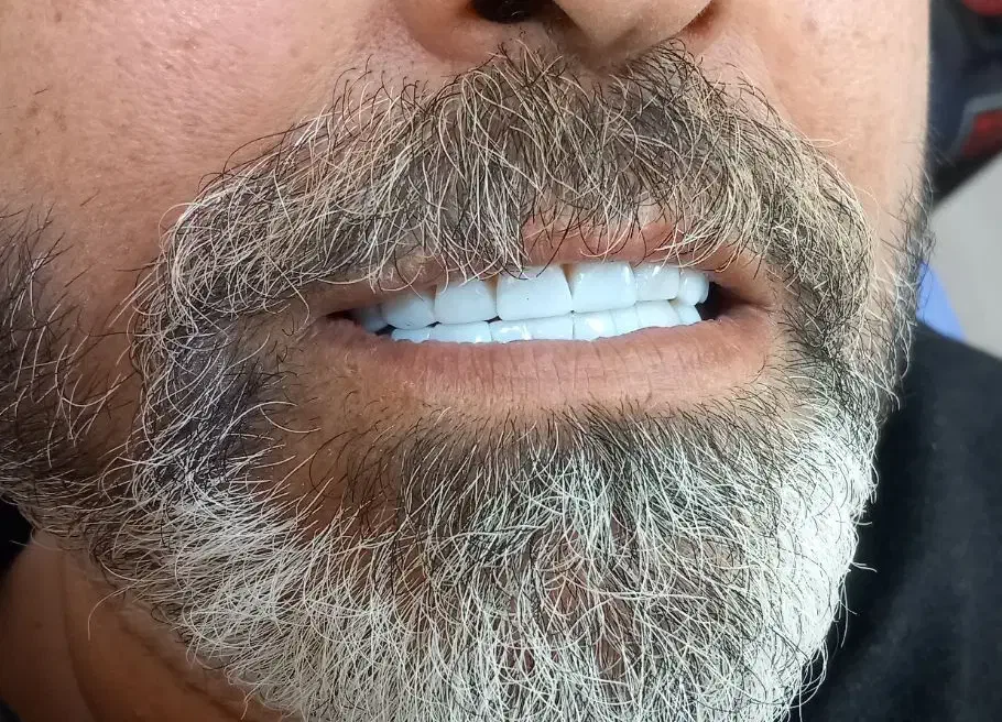 جشنواره خدمات زیبایی دندان با افر 60٪ از دست ندید|خدمات آرایشگری و زیبایی|بابل, |دیوار