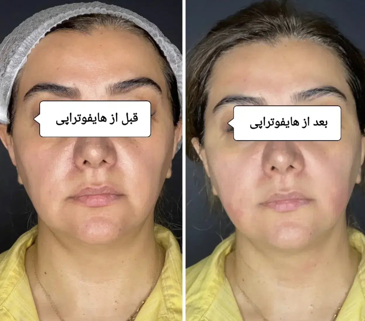 با هایفو ۱۰ سال جوانتر شو|خدمات زیبایی و سلامت|اهواز, کیانپارس |دیوار