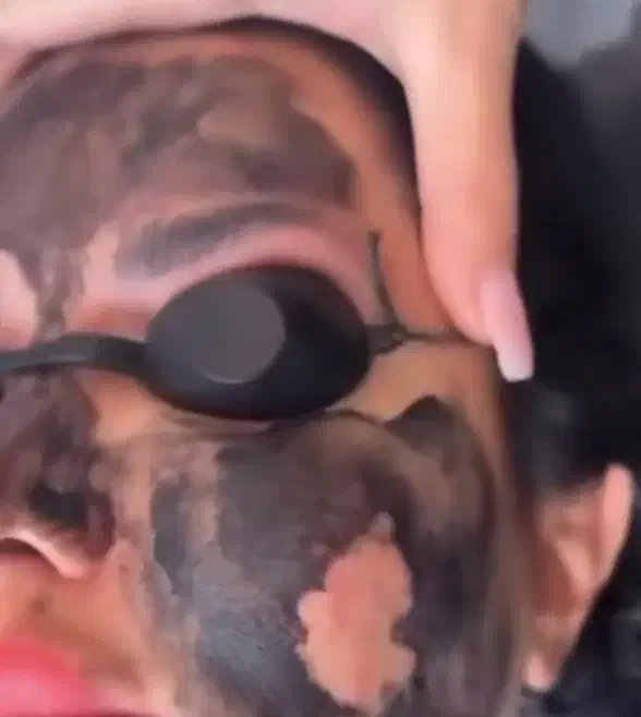 لیزر تضمینی موهای زائد رفع لک روشن کننده|خدمات آرایشگری و زیبایی|رشت, کاکتوس|دیوار