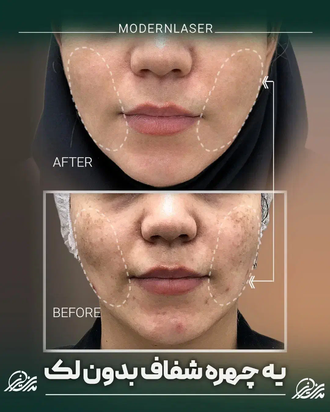 درمان کامل انواع لک پوستی توسط پزشک|خدمات آرایشگری و زیبایی|اصفهان, سعادتآباد|دیوار