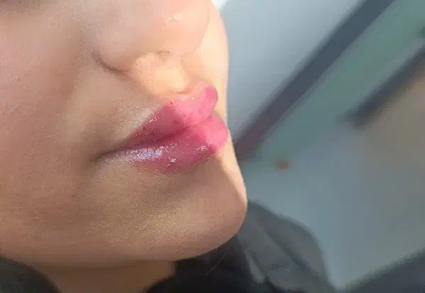 تخفیفات روزمادر تزریق ژل بوتاکس،مزوتراپی،فیلر بادی|خدمات آرایشگری و زیبایی|قم, باسکول|دیوار