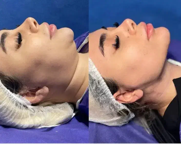 لیپو فیس غبغب و بوکال فت|خدمات آرایشگری و زیبایی|ری, ظهیرآباد|دیوار