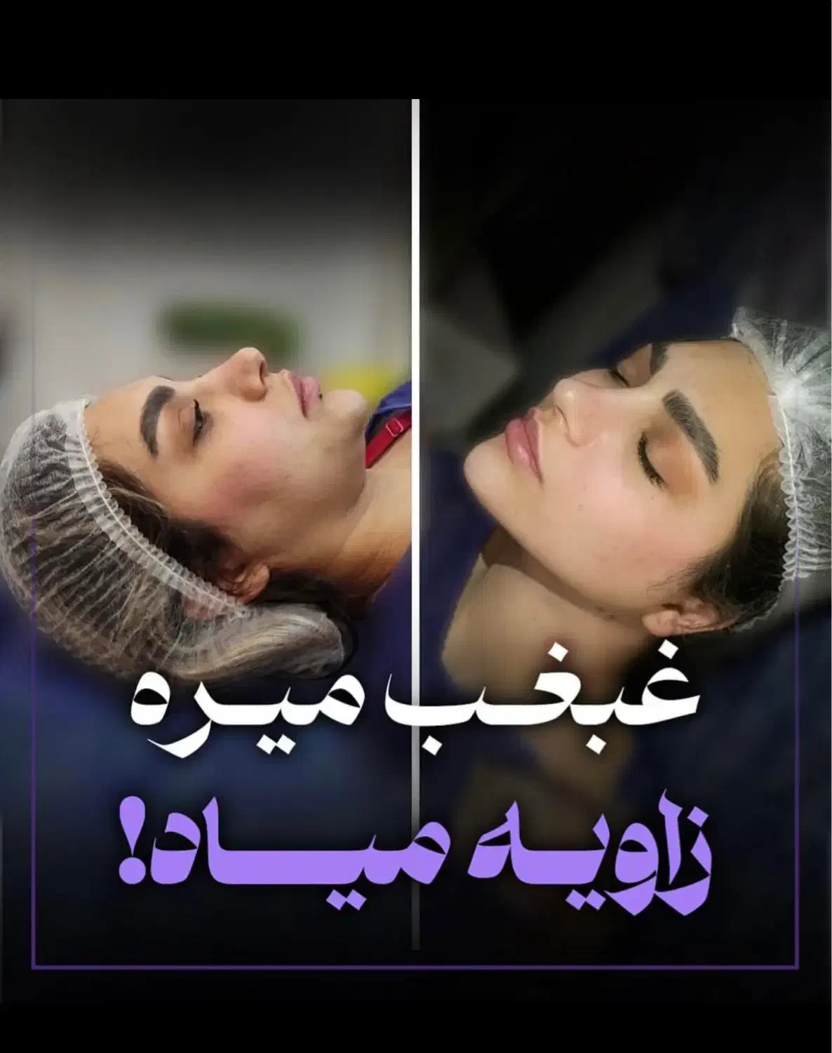 لیپوساکشن غبغب وزاویه سازی و لیفت توسط جراح تضمینی|خدمات آرایشگری و زیبایی|مشهد, راهنمایی|دیوار