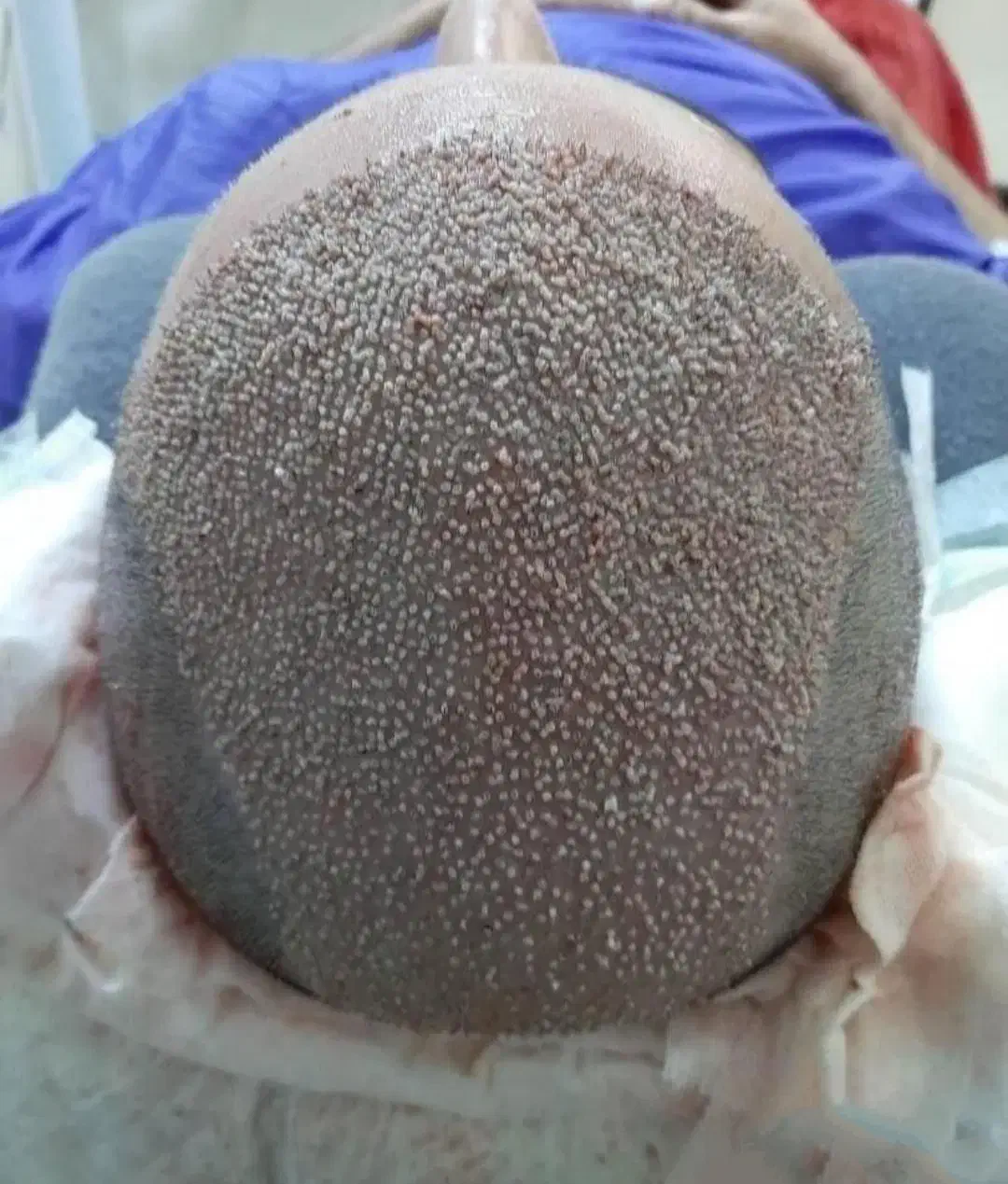 کاشت مو طبیعی له روش میکروfit وsut|خدمات آرایشگری و زیبایی|رامشیر, |دیوار