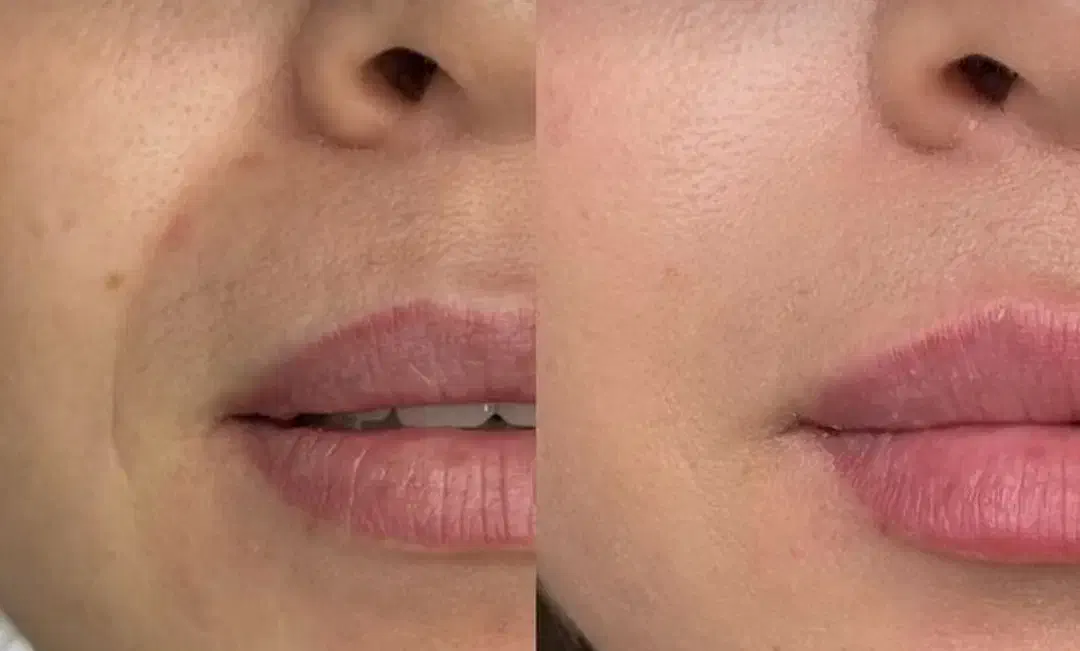 آنزم و مزو تراپی و فیلر و بوتاکس|خدمات آرایشگری و زیبایی|قرچک, مهدیه|دیوار