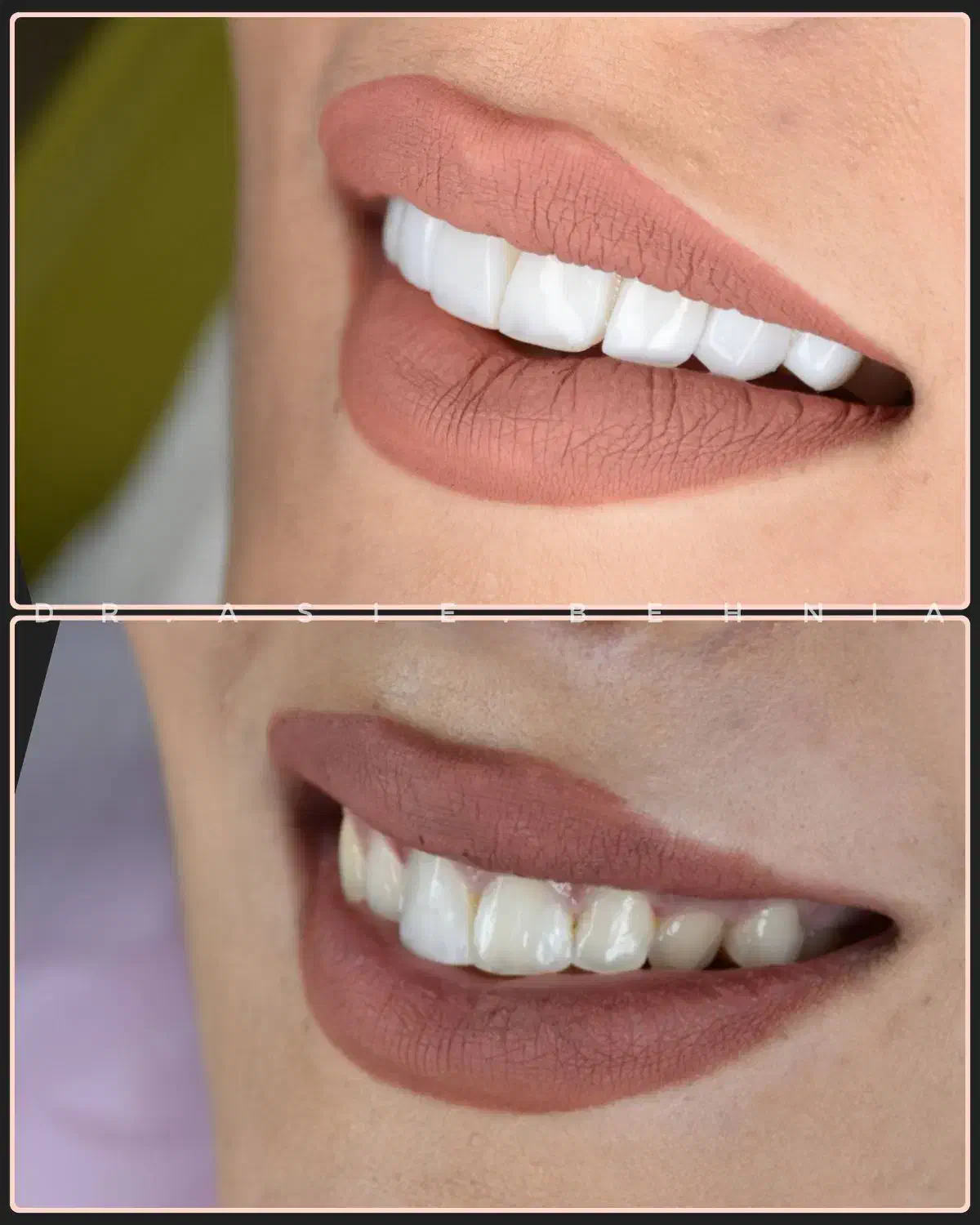 جشنواره کامپوزیت دندان باتخفیف 40درصد درجابرانصاری|خدمات آرایشگری و زیبایی|اصفهان, میرعماد|دیوار