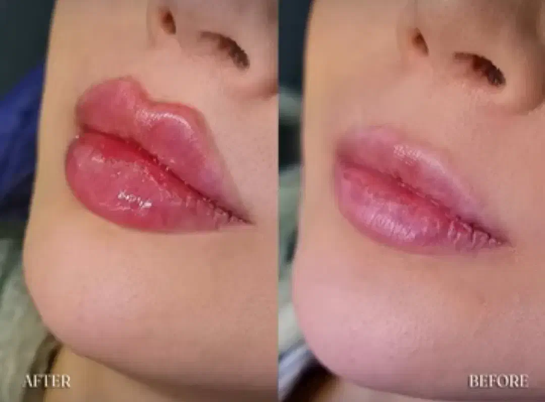 نیازمند مدل تزریق ژل|خدمات آرایشگری و زیبایی|ارومیه, |دیوار