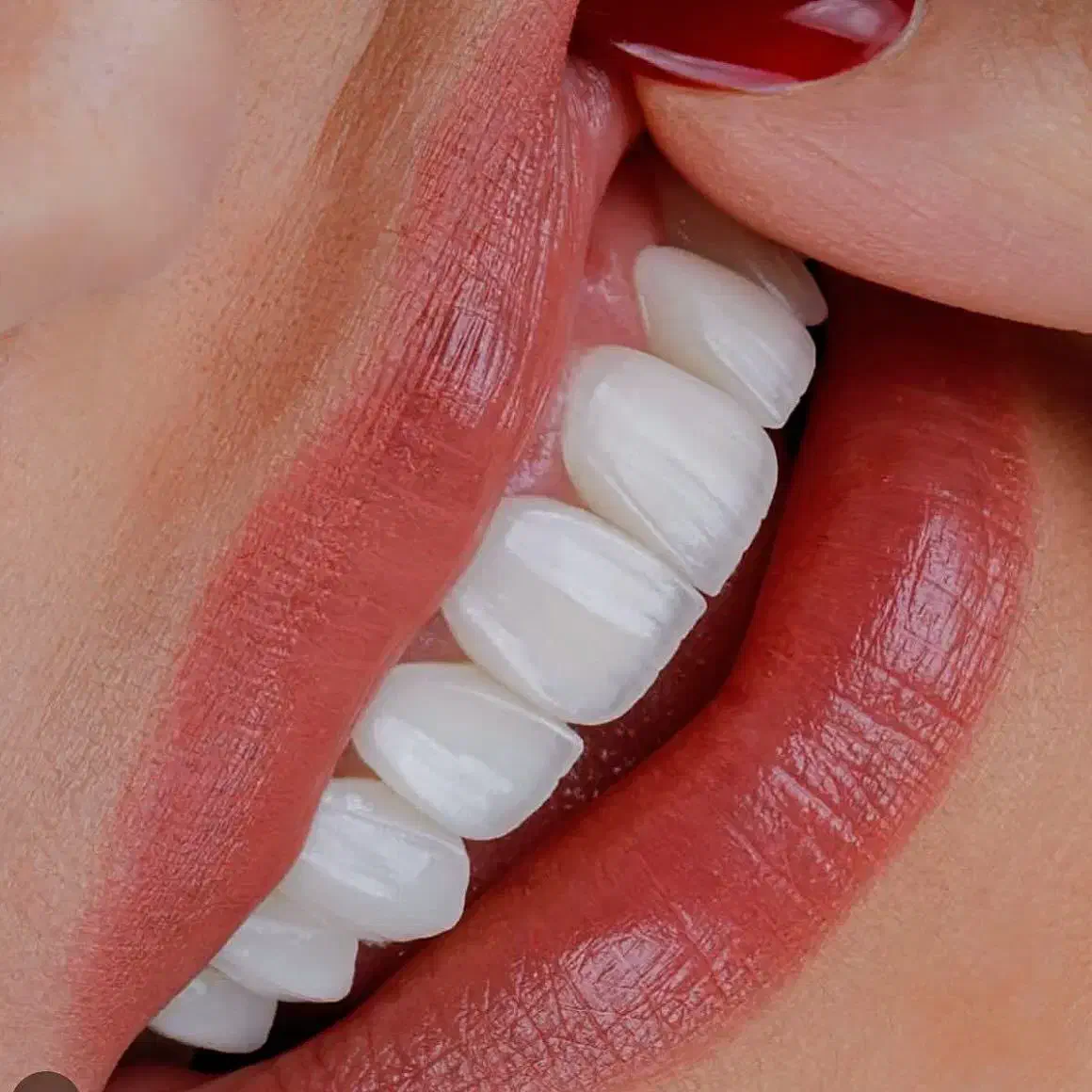 دندانپزشکی ایمپلنت روکش ارتودنسی اقساطی|خدمات آرایشگری و زیبایی|مرند, |دیوار