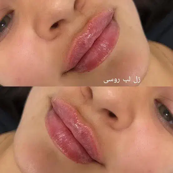تخفیف ۵۰درصدی تزریق ژل چربی بوتاکس و جراحی زنان|خدمات آرایشگری و زیبایی|رشت, گلسار|دیوار