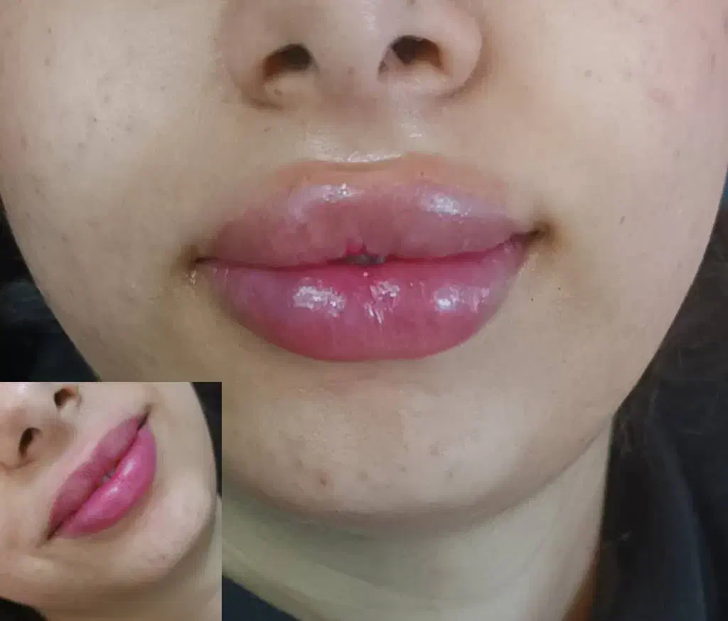 تزریق ژل ،فیلر بوتاکس مزو آنزیم خال برداری|خدمات آرایشگری و زیبایی|الیگودرز, |دیوار