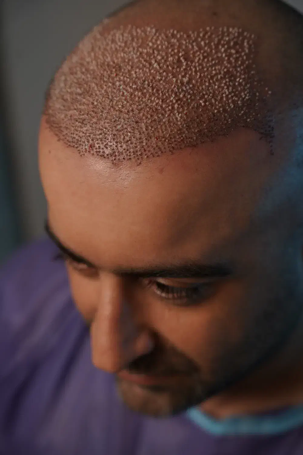 کاشت تخصصی مو به روش FIT|خدمات آرایشگری و زیبایی|رشت, گلسار|دیوار