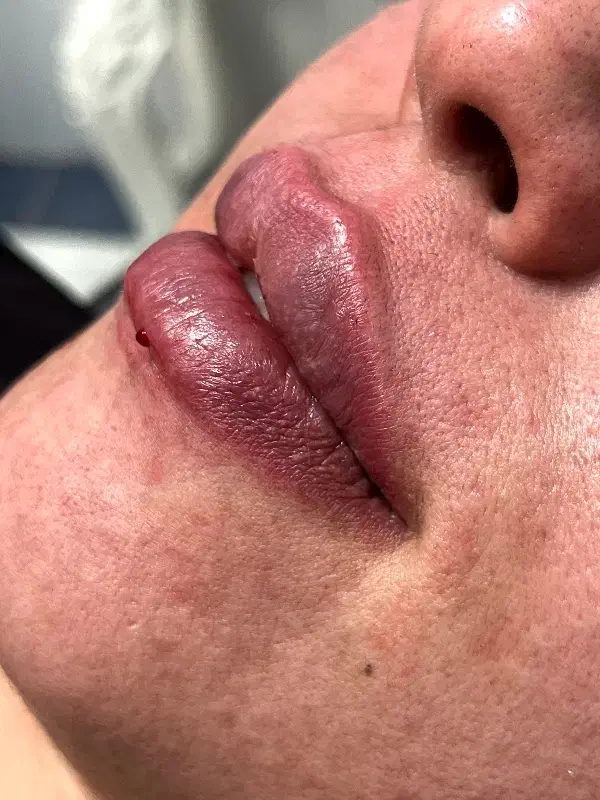 ژل لب فیلر بوتاکس پی ار پی فیلر گونه خط خنده|خدمات آرایشگری و زیبایی|کاشان, طالقانی|دیوار