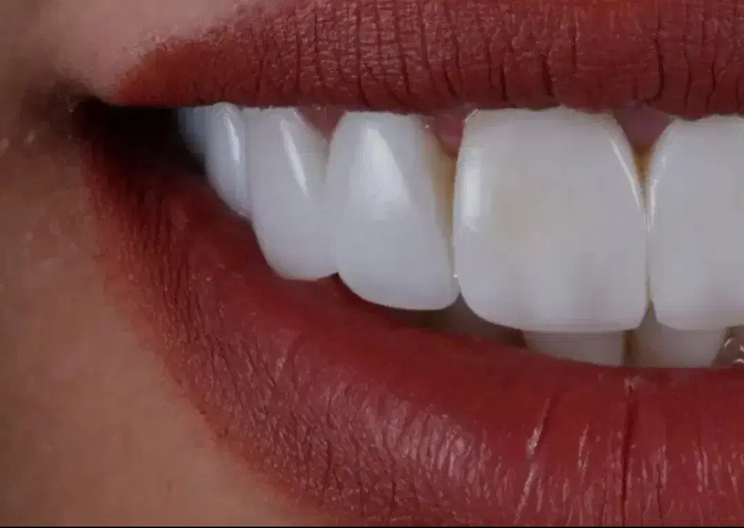 کامپوزیت بدون تراش دندان فکی ۶میلیون|خدمات آرایشگری و زیبایی|قم, شهرک مهدیه|دیوار