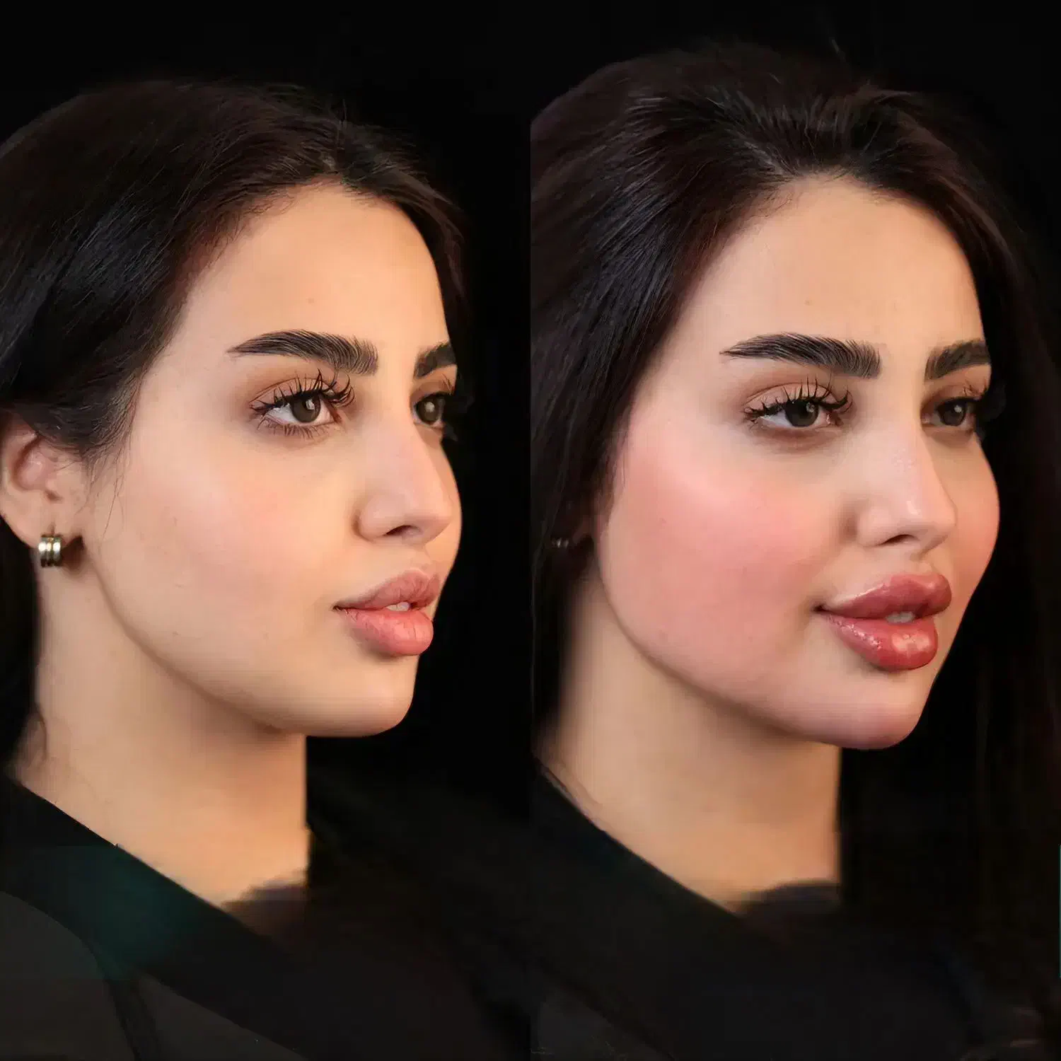 تزریق چربی صورت با ماندگاری ۱۰ ساله - دکتر واحدی|خدمات آرایشگری و زیبایی|قزوین, |دیوار