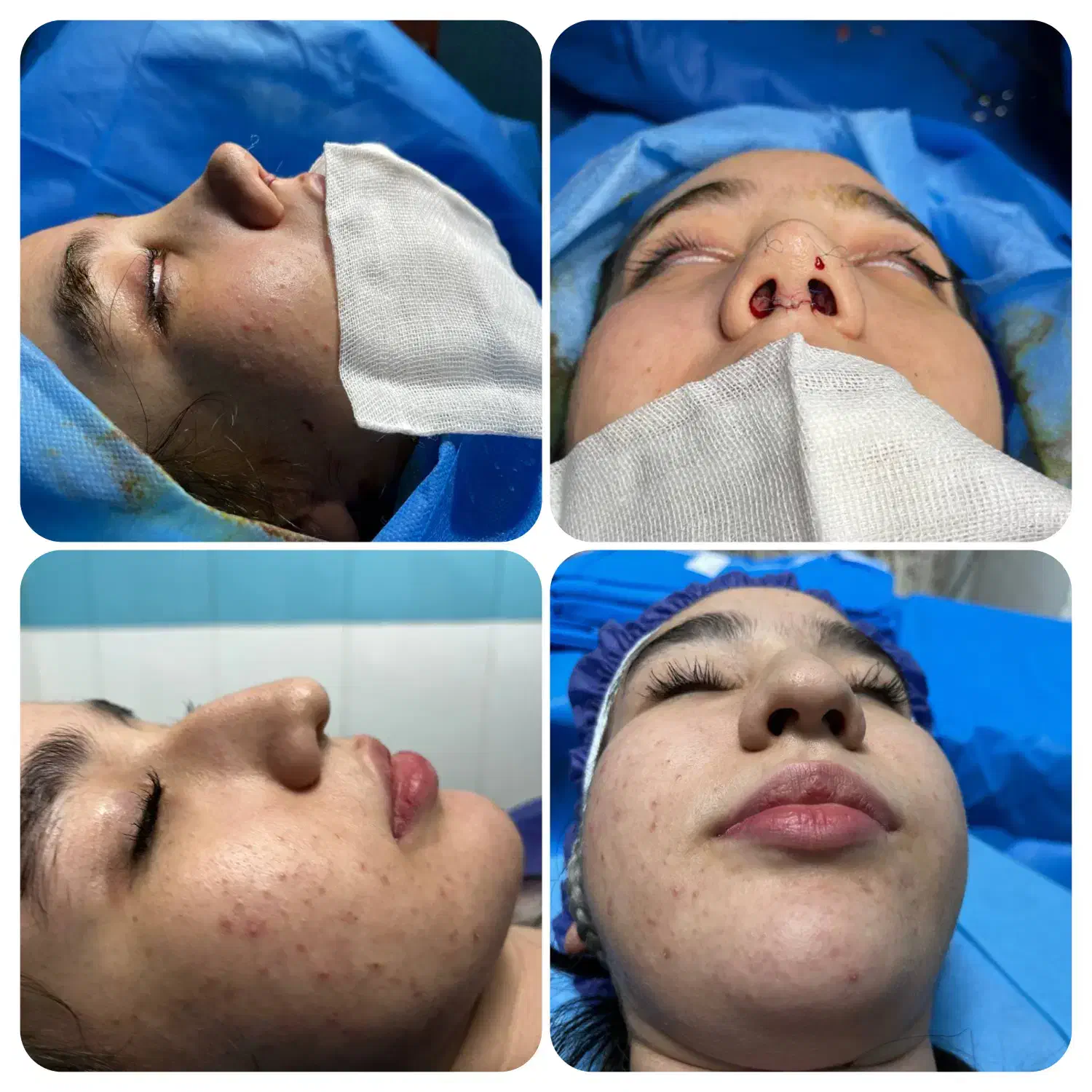 جراحی زیبایی بینی و ترمیمی|خدمات آرایشگری و زیبایی|قائمشهر, |دیوار