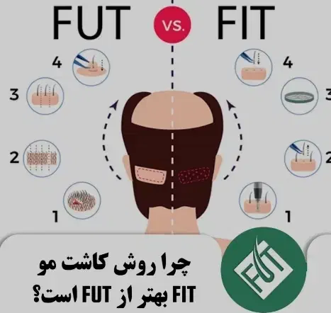 کاشت مو فقط با 17میلیون|خدمات آرایشگری و زیبایی|ماهان, |دیوار