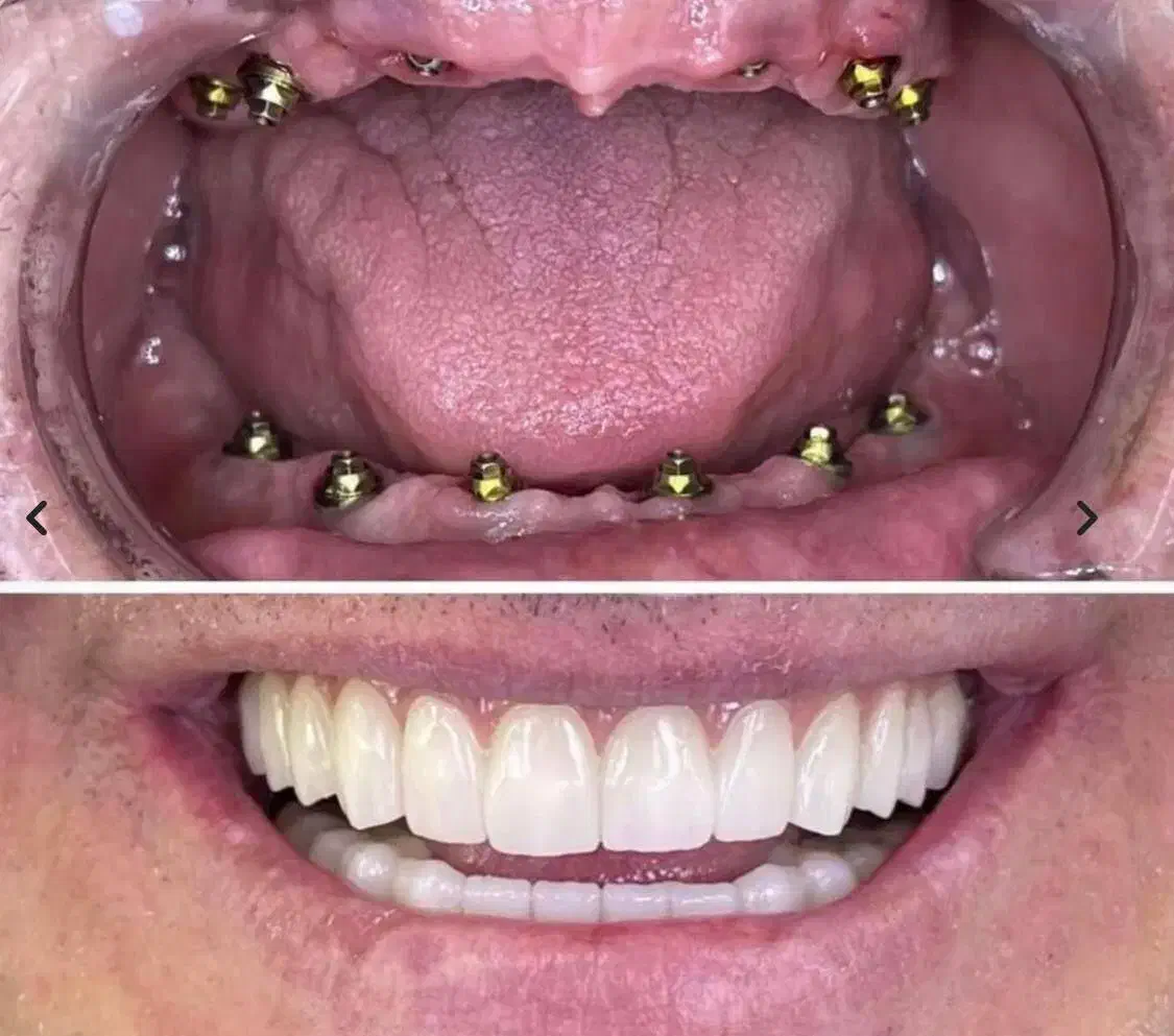 جشنواره دندانپزشکی ایمپلنت ۱۰/۳۰۰|خدمات آرایشگری و زیبایی|سلماس, |دیوار