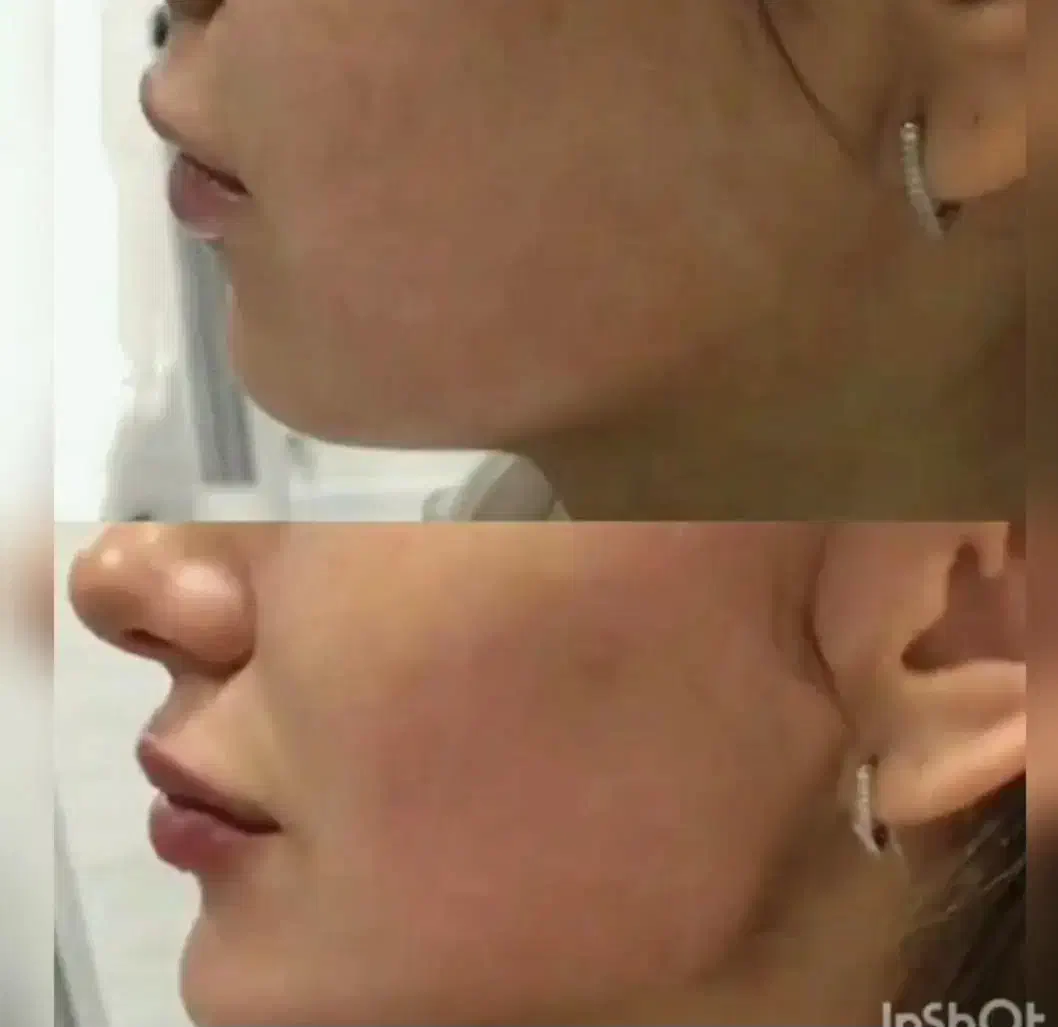 ژل لب.بوتاکس|خدمات آرایشگری و زیبایی|شیراز, شهرک فرزانگان|دیوار