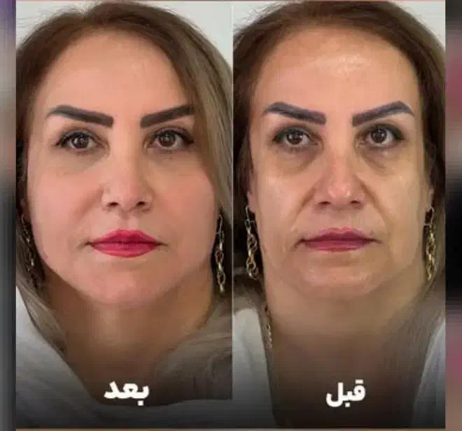 مرکز تخصصی جوانسازی فقط در ۱ جلسه/هایفو/لیفت ۸۹۰ت|خدمات آرایشگری و زیبایی|اصفهان, سودان|دیوار