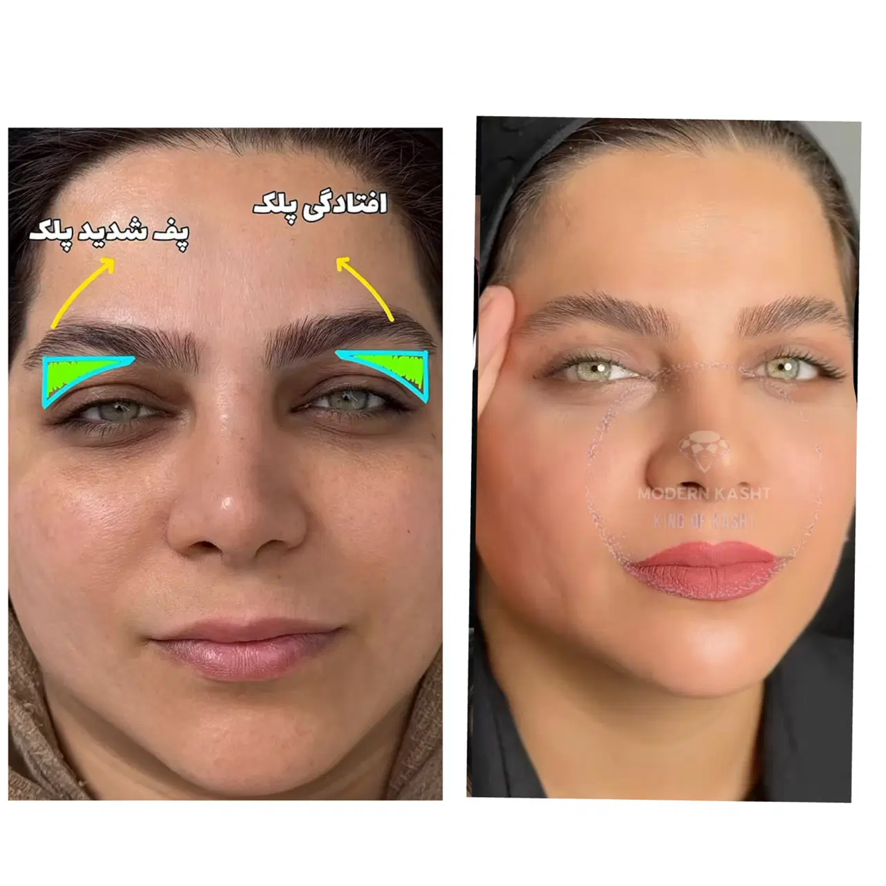 بلفاروپلاستی توسط پزشک ۹کاشت ابرو غبغب لابیاپلاستی|خدمات زیبایی و سلامت|تهران, دریا|دیوار