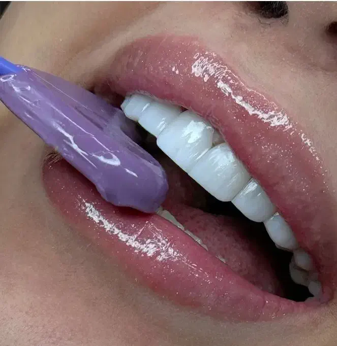 دندانپزشکی کامپوزیت فکی ۸ میلیون با ضمانت ده ساله|آرایشی، بهداشتی، درمانی|رشت, بازار|دیوار