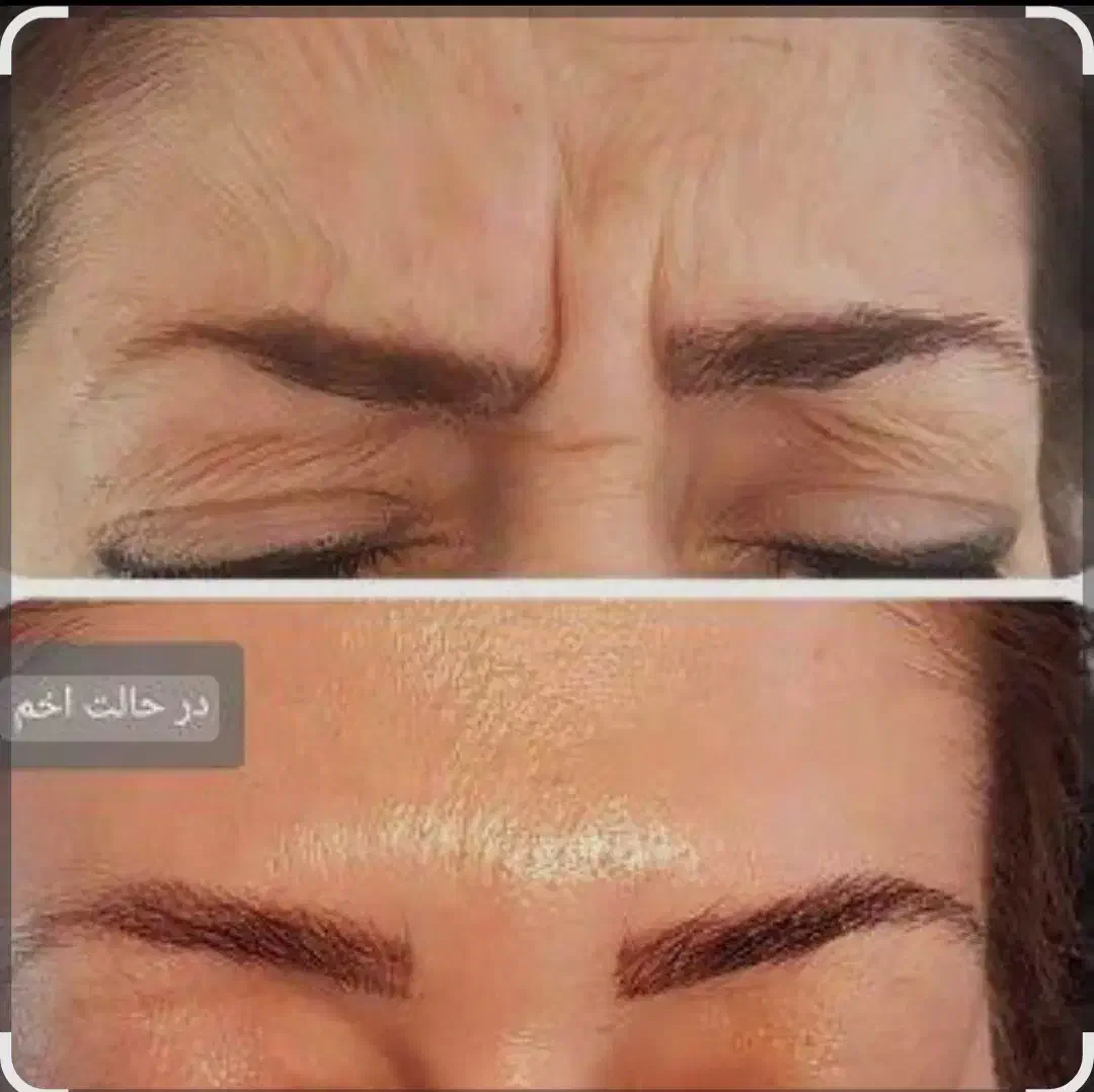 بوتاکس ژل صورت و بدن|خدمات آرایشگری و زیبایی|بیرجند, |دیوار