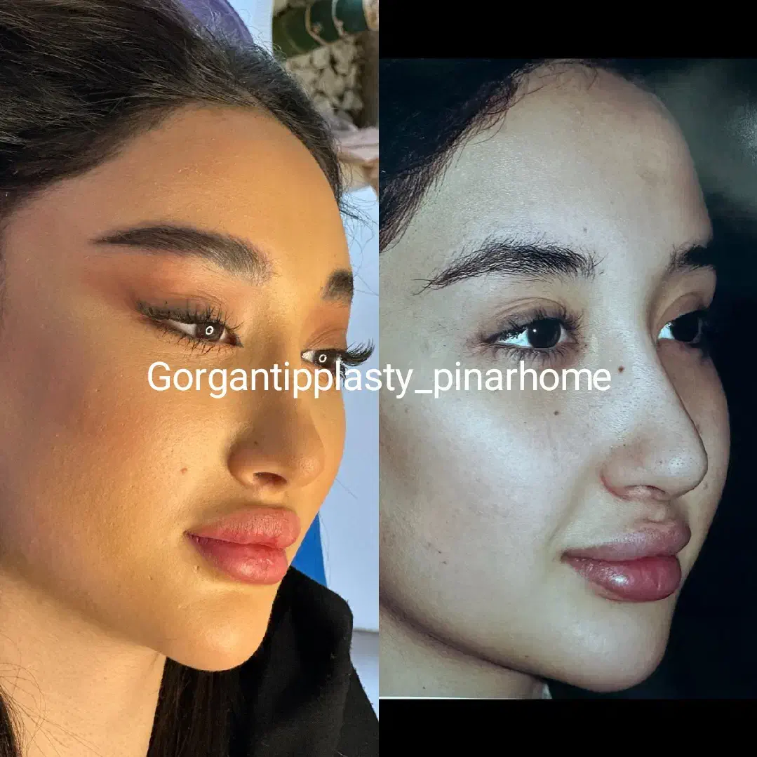 تیپ پلاستی نوک بینی با بی حسی بدون بیهوشی|خدمات آرایشگری و زیبایی|گرگان, |دیوار