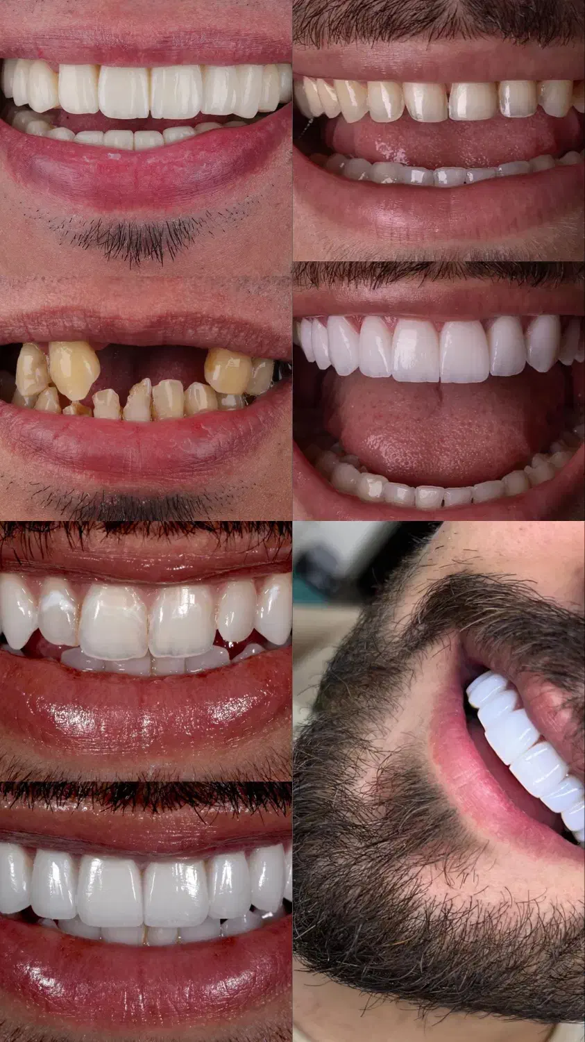 کامپوزیت زیبایی و لمینت دندان(جرمگیری رایگان)|خدمات آرایشگری و زیبایی|شیراز, هفت تنان|دیوار