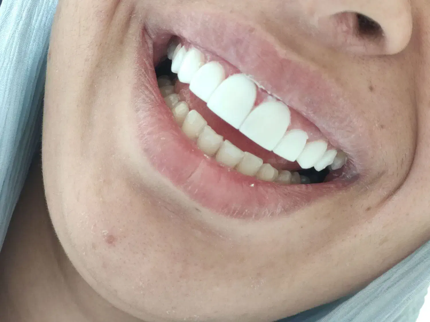 تخفیف کامپوزیت ونیر دندان|خدمات آرایشگری و زیبایی|اردبیل, |دیوار