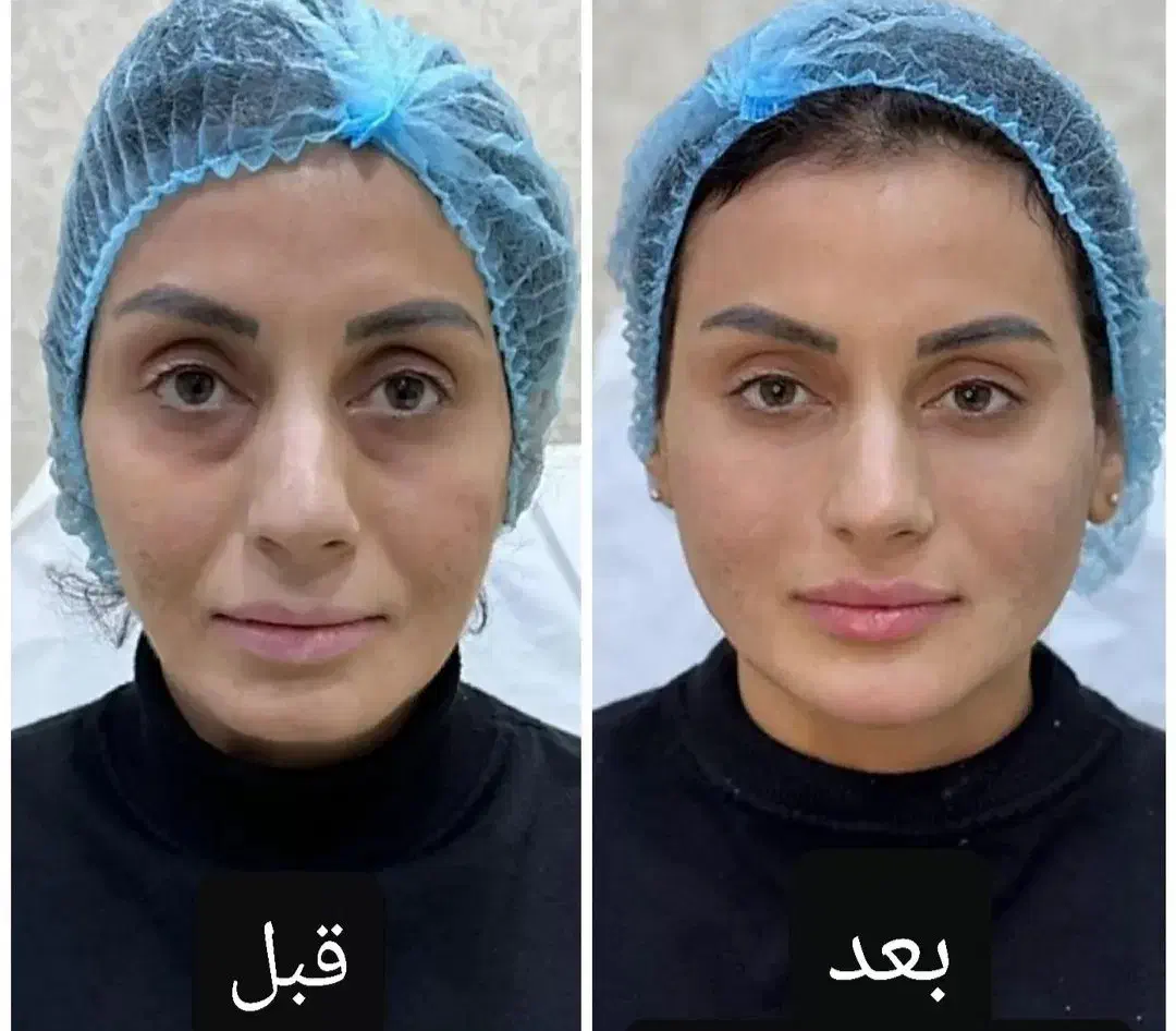 ژل لب زاویه چانه گونه مزوبوتاکس پی ارپی لیزرموزائد|خدمات آرایشگری و زیبایی|مشهد, دانشجو|دیوار