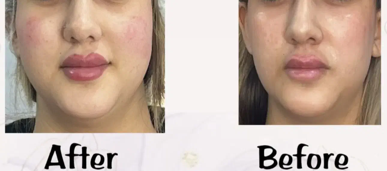 مدل فیلر صورت در کلینیک نوا|خدمات آرایشگری و زیبایی|شیراز, ستارخان|دیوار
